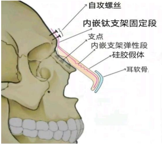 用于鼻尖整形的彈性支架及假體