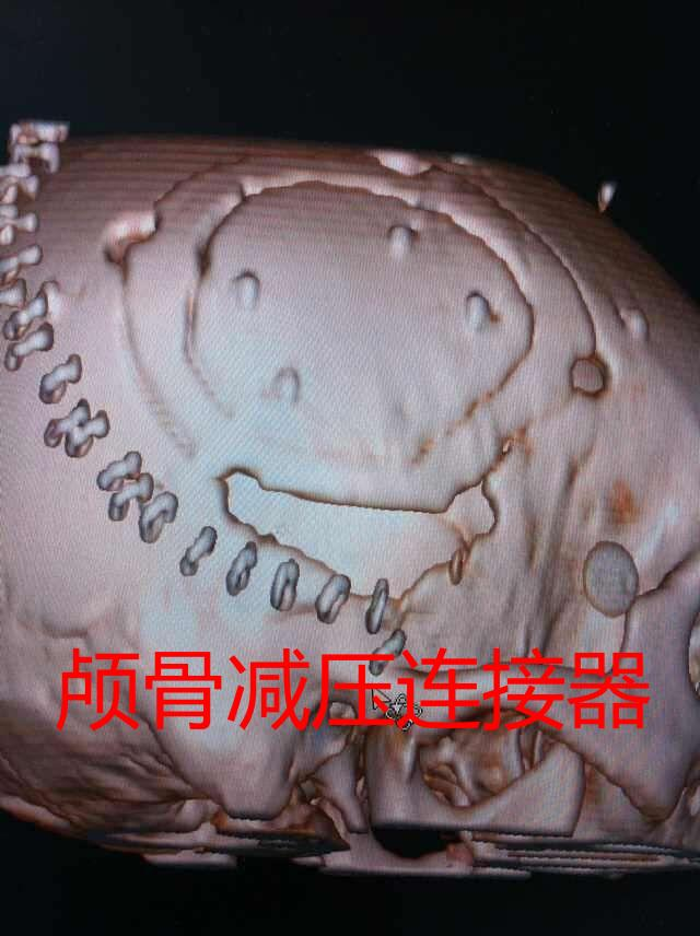 顱骨減壓連接器及系列神經(jīng)外科新產(chǎn)品